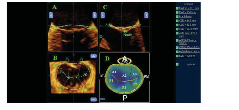 FIGURE 3(Colour online) Three-dimensional morphologic analysis and model of the mitral valve in twin C