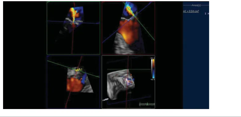 FIGURE 4.(Colour online) Quantiﬁcation of mitral valve regurgitation in twin C using multiplanar reconstruction of the three-dimensional full-volume