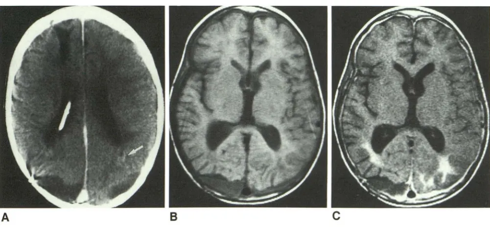 Fig. 5.-Case A, 6. Beam-hardening and metallic artifact 