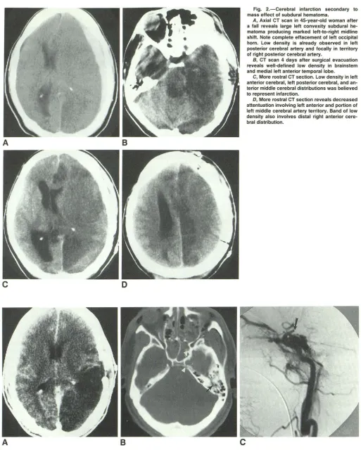 Fig. 2.-Cerebral mass infarction secondary to effect of subdural hematoma. 