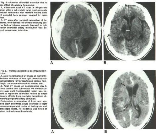 Fig. 4.-Anterior mass choroidal infarction due to effect of subdural hematoma. 