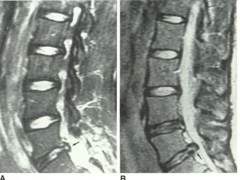 Fig. 1.-A, ittal Prolapsed disk. T2-weighted sag-image <>f lumbar spine shows small protru-