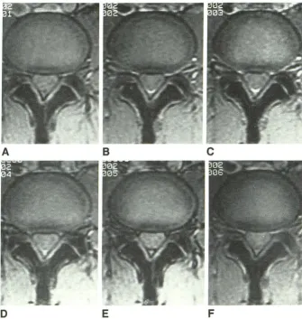 TABLE 1: Delectability of Herniated Nucleus Pulposus by GRE and SE 