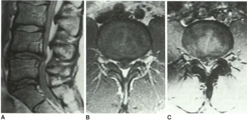 Fig. 5.-A, C, B, T2-weighted sagittal image (2000/70) of prolapsed disk in right lateral recess at L5-S1 level