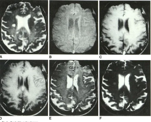Fig. 4.-Focal compared with surrounding white matter. Focal posterior hemispheric white-matter changes visible on sequence