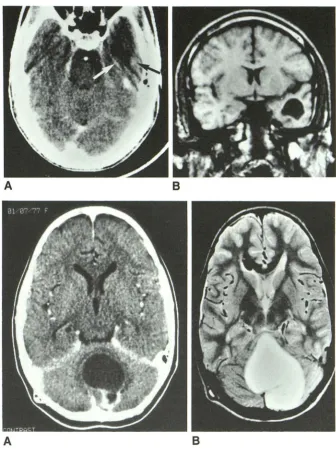 Fig. 1.-Case A, 1. Contrast-enhanced CT scan shows area 