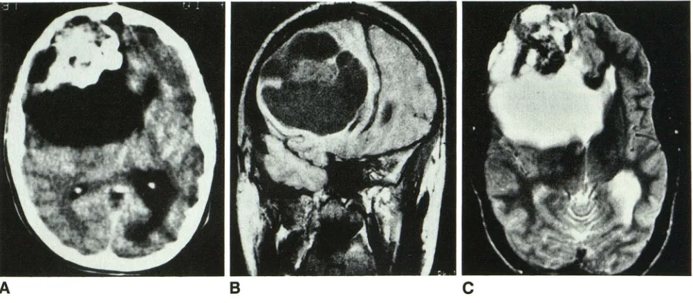 Fig. 3.-Case aspect enhancement. There is dilatation A, C, B, 3. Contrast-enhanced CT scan shows large cystic ganglioglioma occupying right frontal lobe