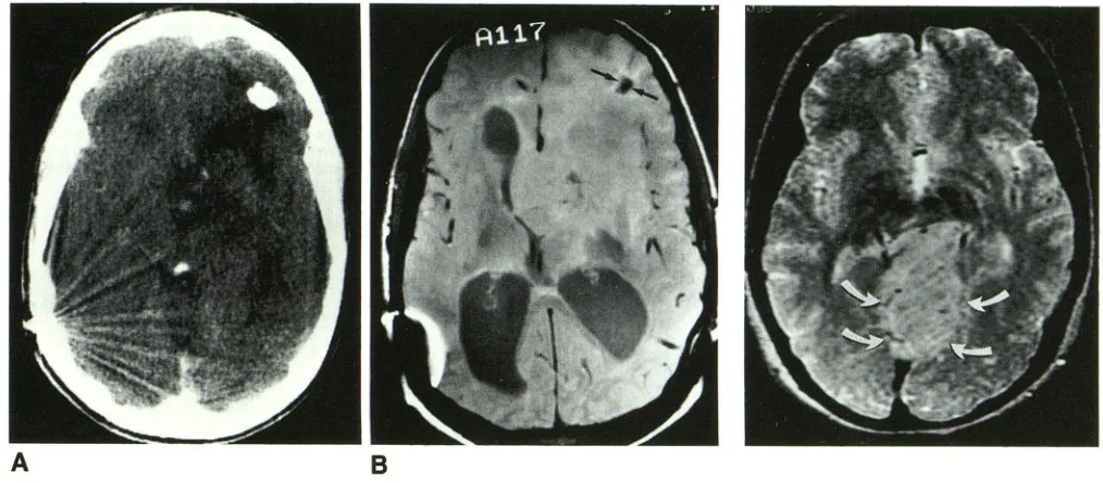 Fig. 6.-Case A, 15. Contrast-enhanced CT scan sho