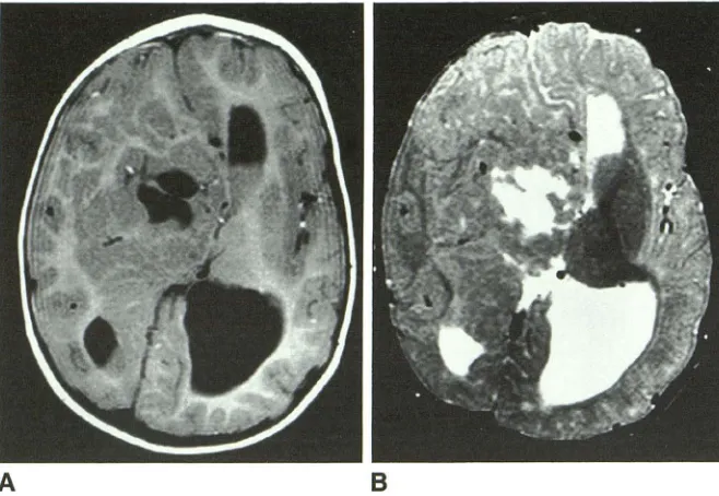 Fig. 8.-Case A, 18. Axial MR image 