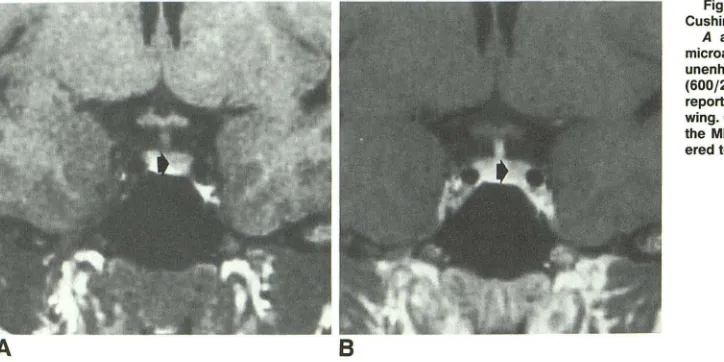 Fig. 4.-Case 5: 31-year-old woman with Cushing disease. 