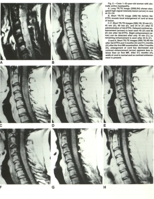 Fig. 2.-Case 1: 43-year-old woman with clin-ically active myelopathy. 