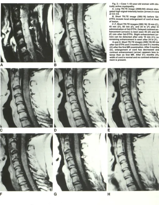 Fig. 2.-Case 1: 43-year-old woman with clin-ically active myelopathy. 