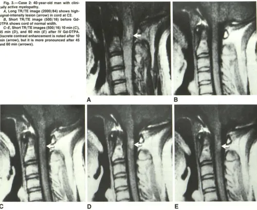 Fig. 3.-Case 2: 40-year-old man with clini-cally active myelopathy. 