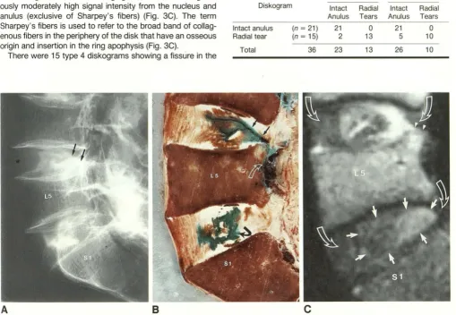 TABLE 1: Cryomicrotomy and Dlskography Compared for Detection of Anular Tears 