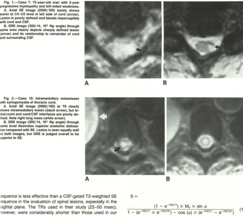 Fig. 1.-Case 7: 75-year-old man with 2-year progressive myelopathy and left-sided weakness