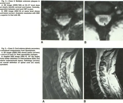 Fig. 4.-Case 4: Multiple sclerosis plaques in cervical cord. 