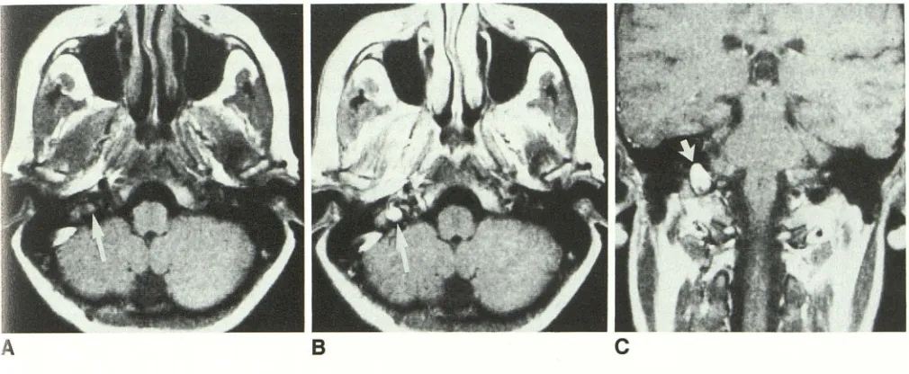 Fig. 2.-Small A, glomus jugulare tumor on right. Nonenhanced axial image, 500/28, shows mass (arrow) in temporal bone measuring 1 x 1