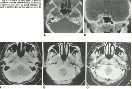Fig. 4.-A opacification and 8, On axial scan (A) there is of the sphenoid sinus. Destruction 