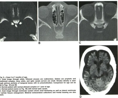 Fig. 2.-Case A, 4 at 7 months of age. Axial image through orbits. Ethmoid sinuses are rudimentary