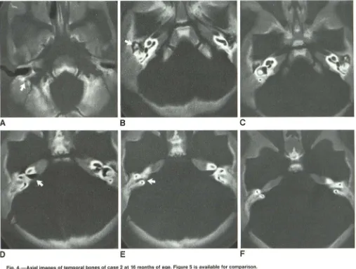 Fig. 4.-Axial Prominent represents A, D-FB images of temporal bones of case 2 at 16 months of age