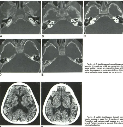Fig. 6.-A tricular system larged. Parietal Ventricles and and B, Axial images through ven-of case 2 at 9 months of age