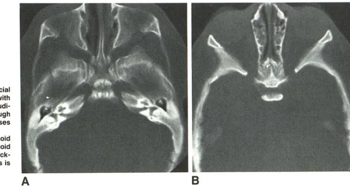 Fig. 7.-Case A, 8 at 23 months of age. Axial images through temporal and facial 