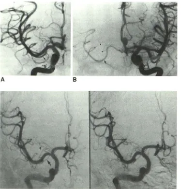 Fig. 1.-Accessory middle cerebral artery arborizing basal perforating ar-