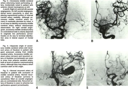 Fig. 3.-Accessory middle cerebral artery arborizing basal perforating ar-