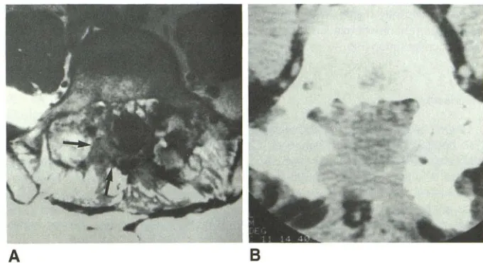 Fig. 3.-A, shows superior csoft-tissue delineation Axial MR image (1000/25) at 1.5 T afforded 