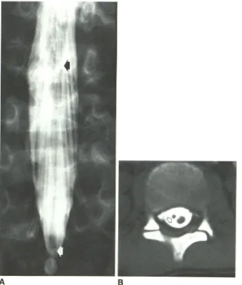 Fig. 2.-8-year-old limbs, urinary boy with pain in both lower frequency, and fecal incontinence
