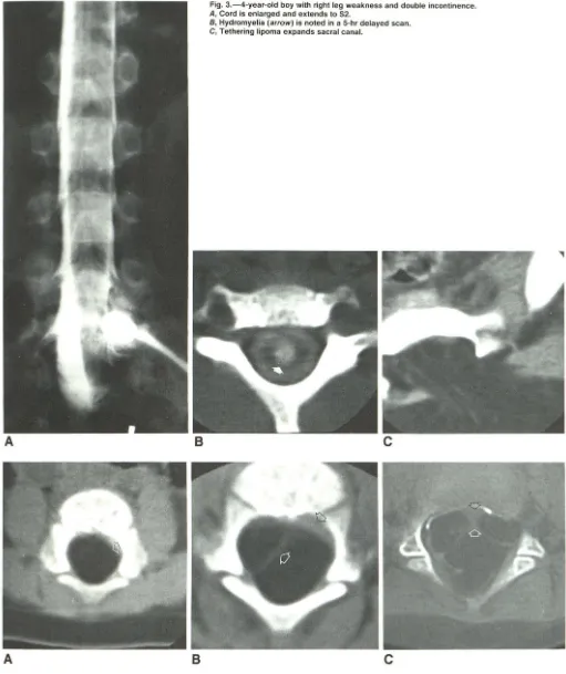Fig. 4.-lntracanalicular because A, C, Branching B, lipomas in three patients. Placode and lipoma interface (arrow) is well defined without change in lipoma to suggest presence of neural tissue