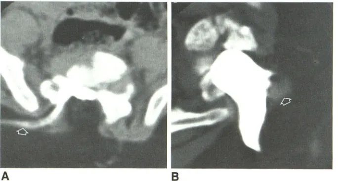Fig. 5.-8-month-old boy with right buttock mass. 