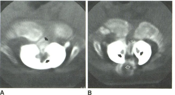Fig. 10.-5-month-old matomyelia. Patient had sacral girl with L5/S1 diaste-dimple and no 