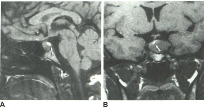 Fig. 3.-Group A I, case 4: Prolactinoma. and 8, Large intrasellar tumor and bright 