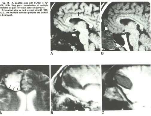 Fig. 14.-A(150/10/4). Very good visualization , Sagittal slice with FLASH = 70° of multiple 