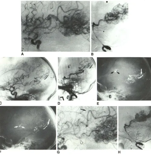 Fig. 1.-Case artery is noted loop and segment of vessel. A, F, C and E, B, G and 1: Sequential angiograms