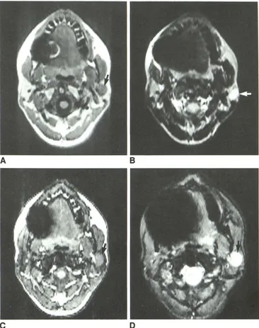 Fig. 4.-Case A, 4: mixed tumor. Standard T1-weighted spin-echo 