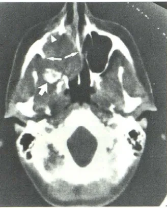 Fig. 1.-Axialarge amorphous calcification (arrowhead) into right infratemporal fossa is appreciated but poorly defined, with a l CT of maxillary sinus chondrosarcoma