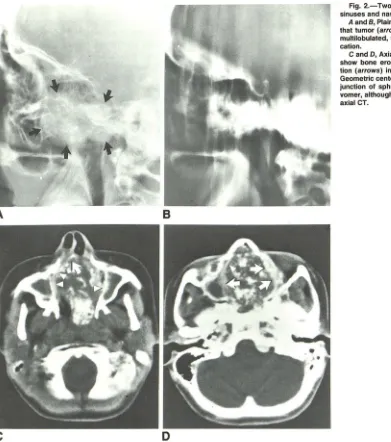 Fig. 2.-Two chondrosarcomas of paranasal sinuses and nasal cavity. 