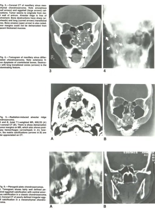 Fig. 3.-Coronal rowheads) Tumor margins could (small involvement. Bone destructions have sharp cifications