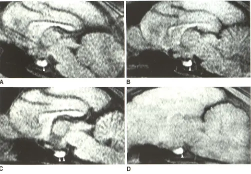 Fig. 2.-Midsagitlal epinephrine injection and increased reimaged 72 hr postmortem. Volume A, MR image of cat brain