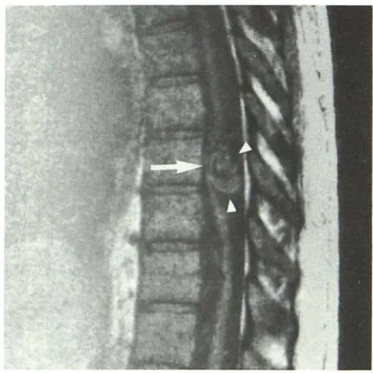 Fig. 7.-Perimedullary 38-year-old patient. Sagittal abnormal signal structures thoracic area, spinal cord is displaced forward fistula above conus medullaris in a Tl-weighted (400/28) image