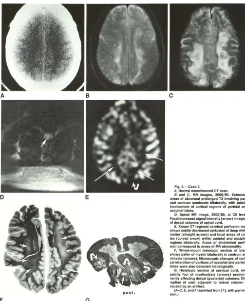 Fig. 3.-Case A, 2. Normal nonenhanced CT scan. 