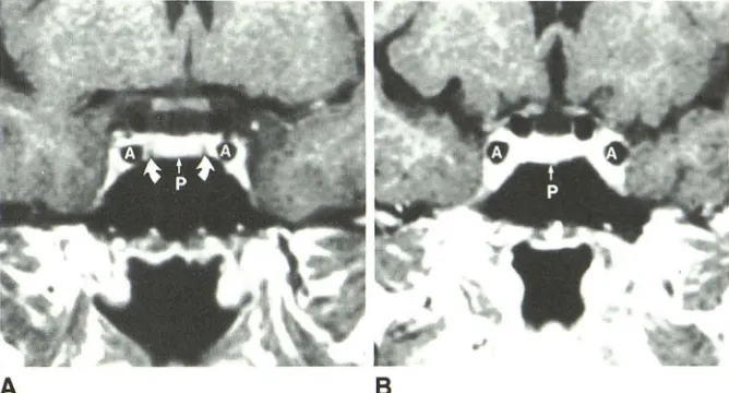 Fig. are shown as but are not visualized in B, pituitary glands and cavernous sinuses in coro-nal T1-weighted spin echo images ing pituitary gland olinium administration