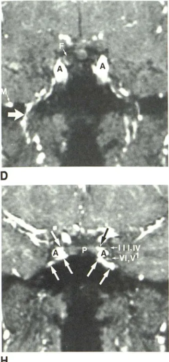Fig. S.-A arrow) and 8, Pituitary adenoma (long in coronal T1-weighted spin echo (A) and 