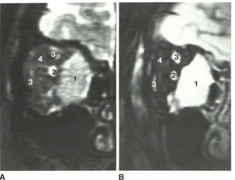 Fig. 3.-lnflammatory A, orbital pseudotumor. Coronal SE image, 600/20. 