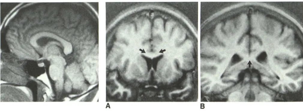 Fig. 2.-Normal1600/600/40, 10-mm-thick sagittallR image, , of left-handed man. 