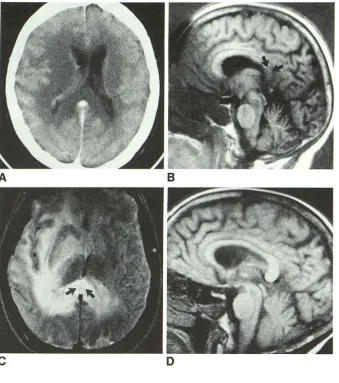 Fig. 6.-62-year-old proved woman with biopsy-grade II astrocytoma of the splenium. 