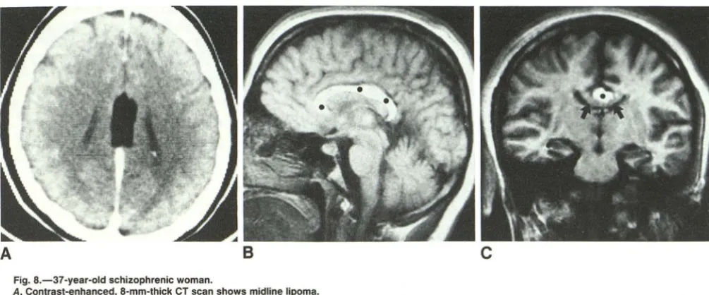 Fig. 9.-38-year-old into corpus callosum caused woman with hemorrhage by pericallosal ar-
