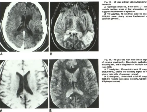 Fig. 10.-51-year-old man with multiple infarct dementia. 
